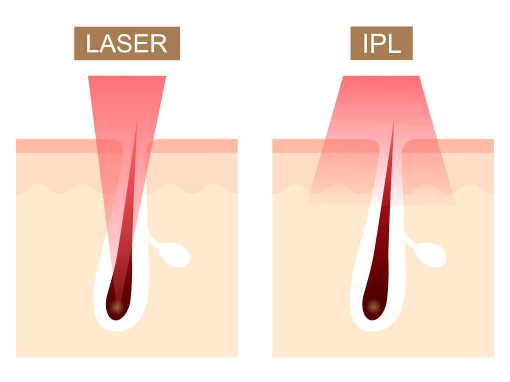bästa IPL laser hårborttagning hemma